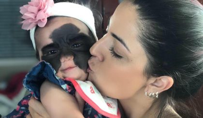 Bebê nasce na Flórida com mancha rara no rosto
